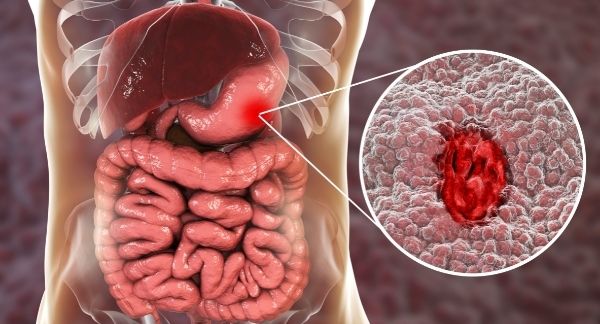 Penyakit Gastritis (Maag): Panduan Lengkap Mengenal Peradangan Lambung, dari Penyebab Hingga Pencegahan