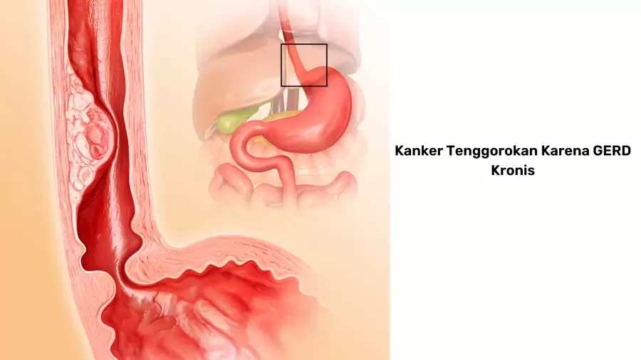 Bahaya Asam Lambung Naik (GERD): Bisakah Memicu Kanker Tenggorokan?
